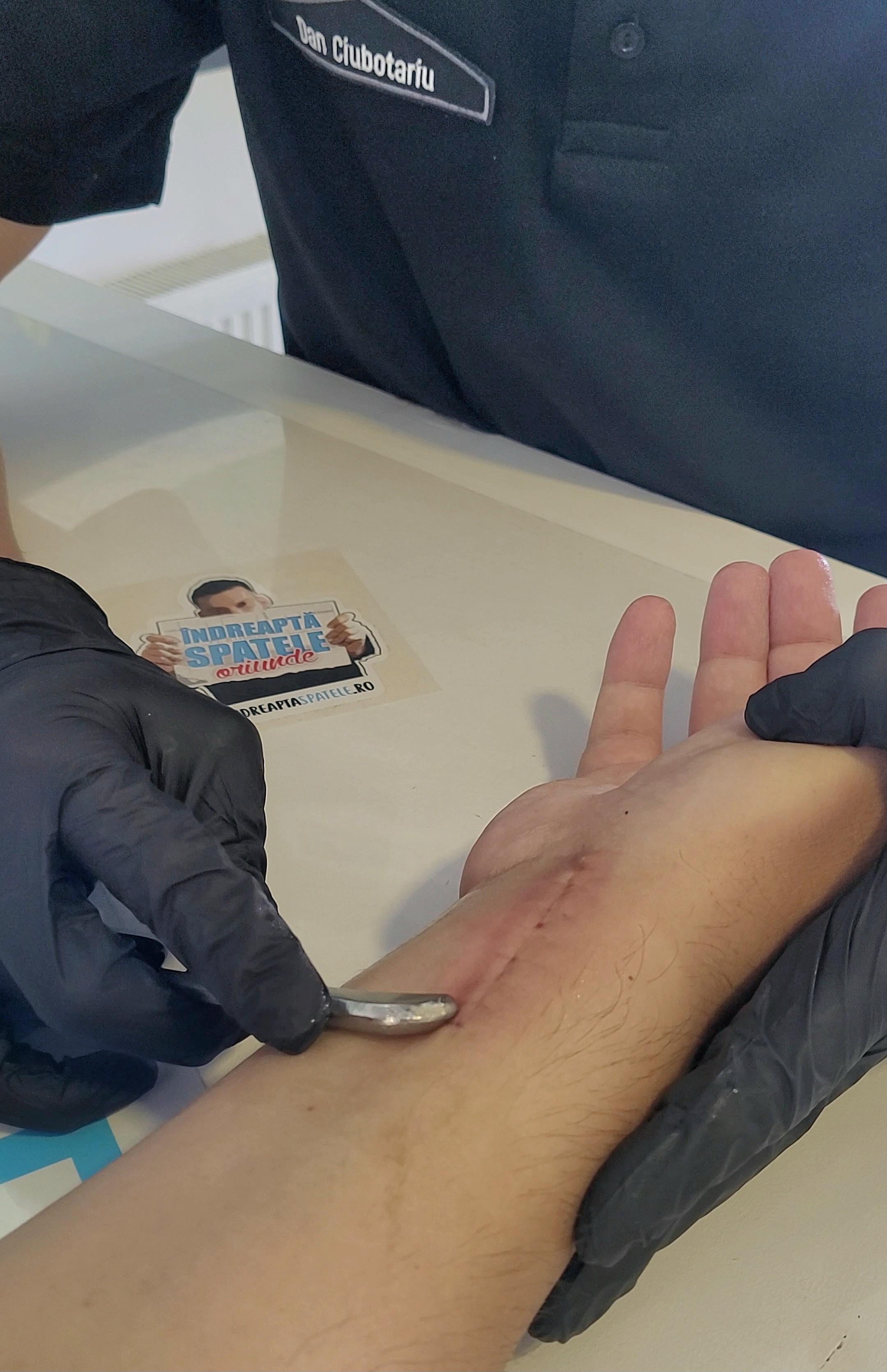Vindecare cicatrice dupa operatie IASTM Iasi