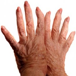 afectarea șoldului cu artrită reumatoidă durere în deget în articulație