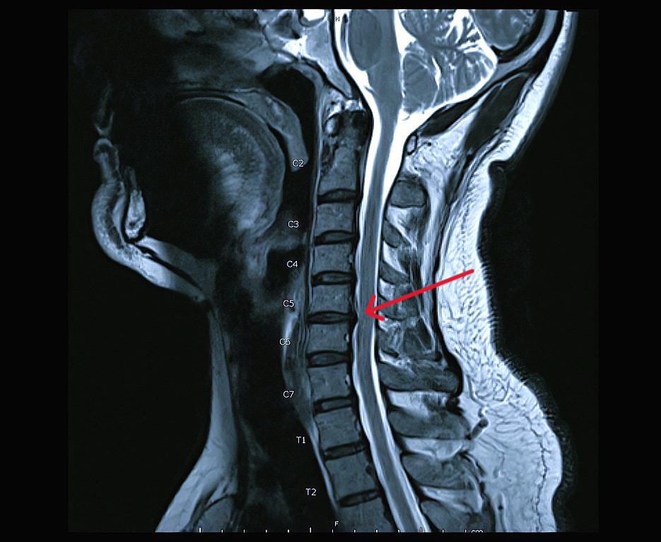 Protruzie discală cervicală C5-C6 fără operație